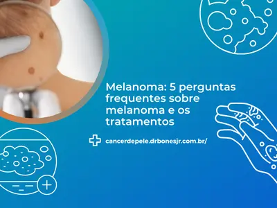 Melanoma 5 perguntas frequentes sobre melanoma e os tratamentos