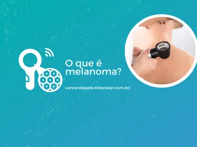 O que é melanoma