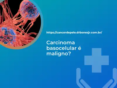 Carcinoma basocelular é maligno