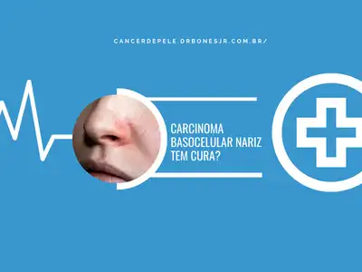 Carcinoma basocelular nariz tem cura