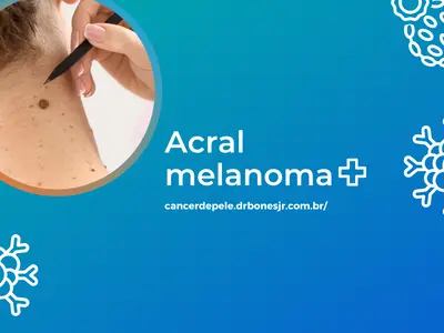Acral melanoma
