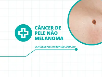 Câncer de pele não melanoma