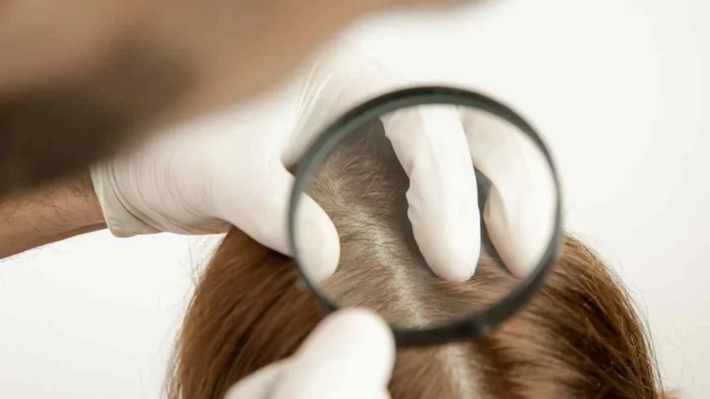 Exemplo de Carcinoma basocelular no couro cabeludo