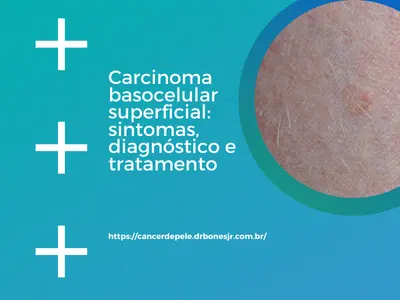 Carcinoma basocelular superficial sintomas, diagnóstico e tratamento