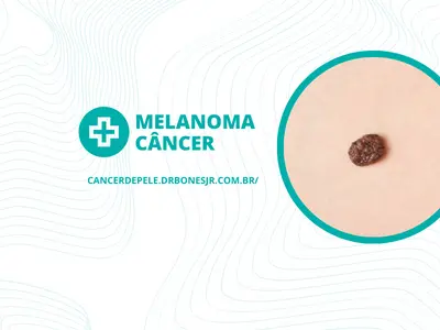 Melanoma câncer