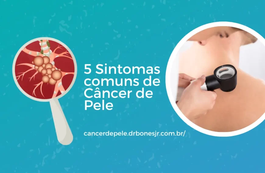 5 Sintomas comuns de Câncer de Pele