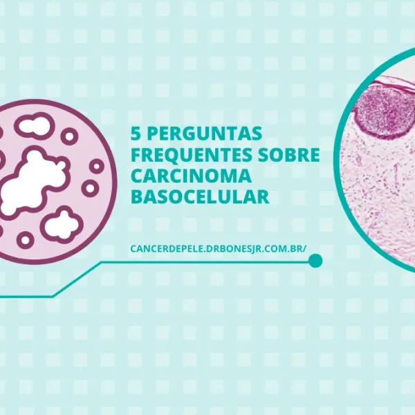 5 perguntas frequentes sobre carcinoma basocelular