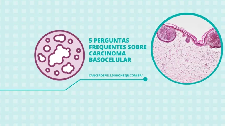 5 perguntas frequentes sobre carcinoma basocelular