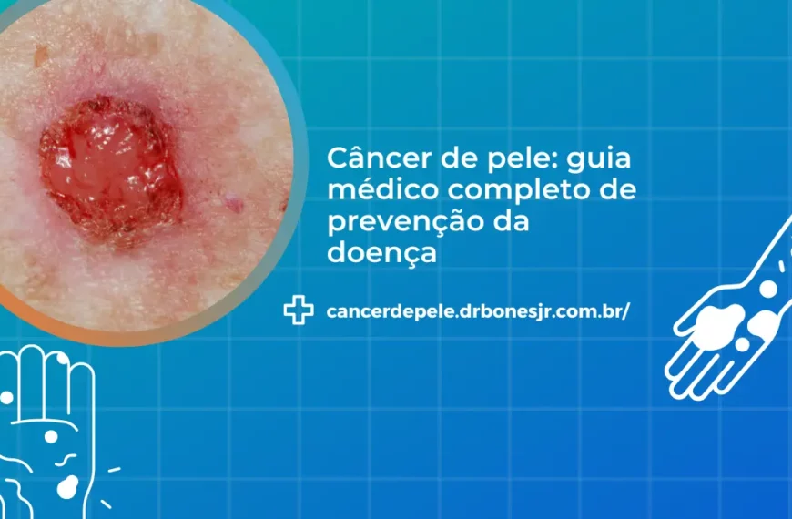 Câncer de pele guia médico completo de prevenção da doença