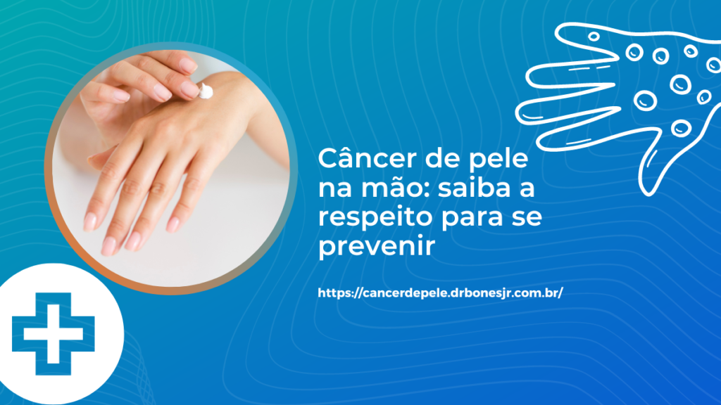 Câncer De Pele Na Mão Saiba A Respeito Para Se Prevenir Especialista Em Câncer De Pele