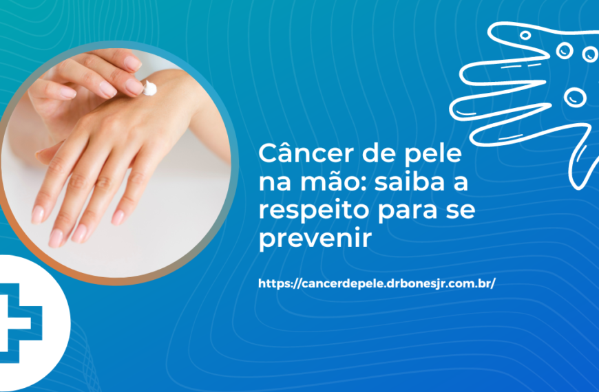 Câncer de pele na mão saiba a respeito para se prevenir