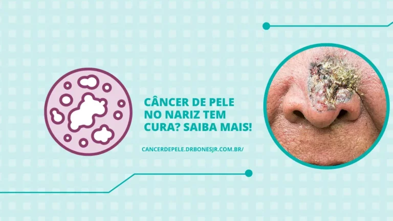 Câncer de pele no nariz tem cura Saiba mais!
