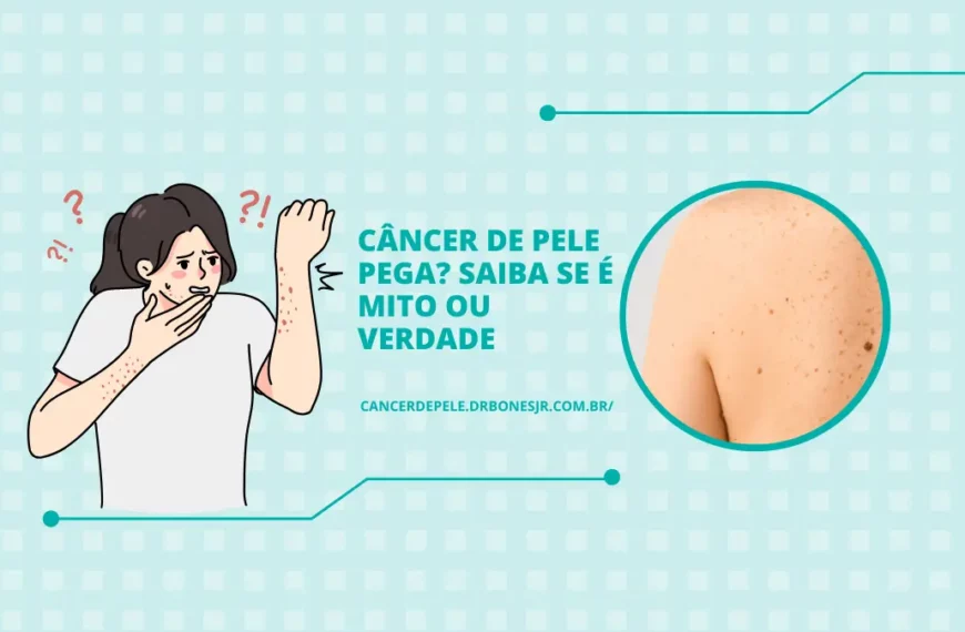 Câncer de pele pega saiba se é mito ou verdade