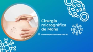 Cirurgia micrográfica de Mohs