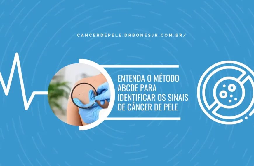 Entenda o método ABCDE para identificar os sinais de câncer de pele