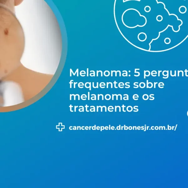 Melanoma 5 perguntas frequentes sobre melanoma e os tratamentos