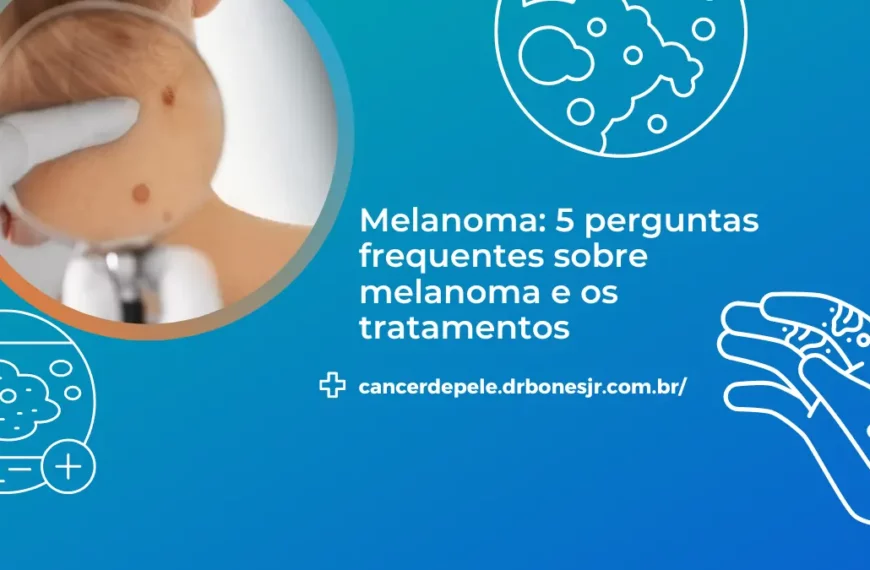 Melanoma 5 perguntas frequentes sobre melanoma e os tratamentos