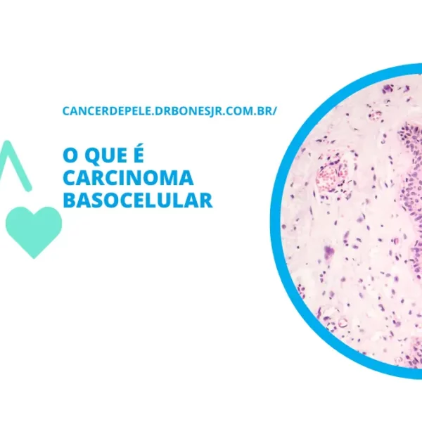 O que é carcinoma basocelular