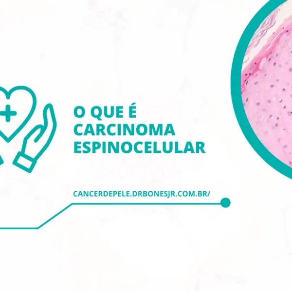 O que é carcinoma espinocelular