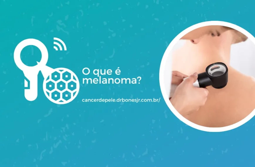 O que é melanoma