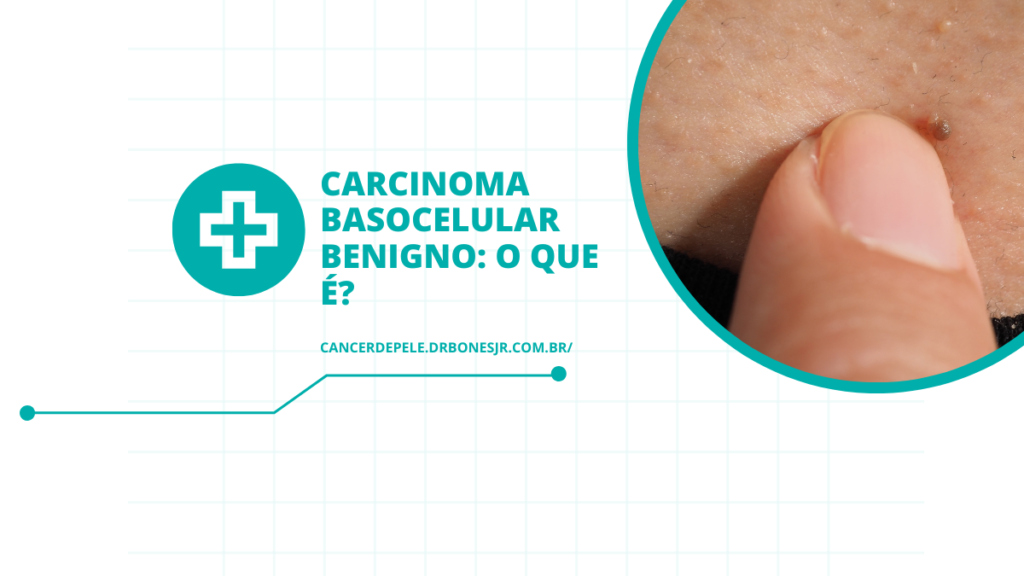 Carcinoma basocelular benigno o que é