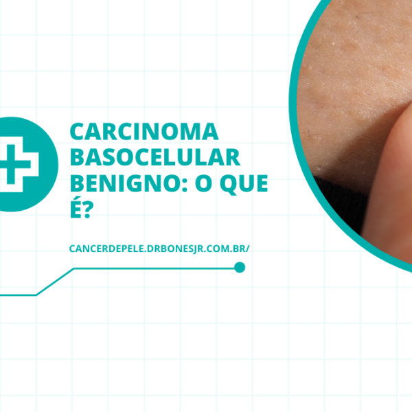 Carcinoma basocelular benigno o que é