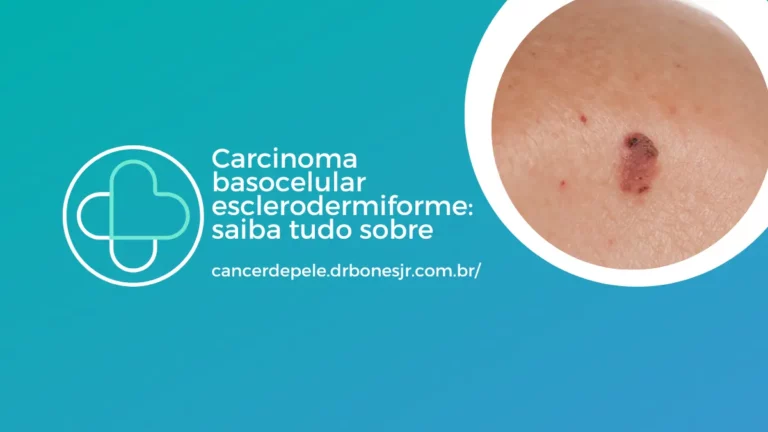 Carcinoma basocelular esclerodermiforme saiba tudo sobre