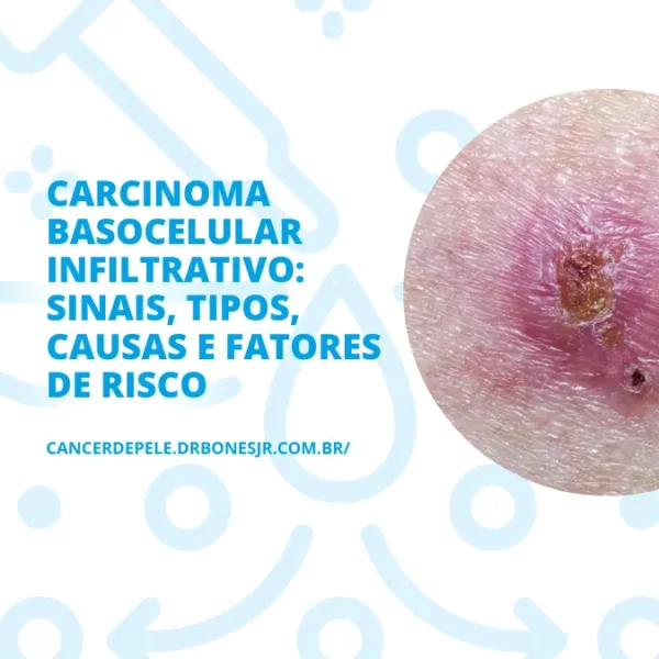 Carcinoma basocelular infiltrativo sinais, tipos, causas e fatores de risco