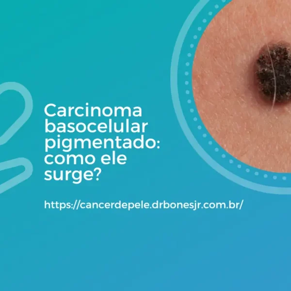 Carcinoma basocelular pigmentado como ele surge