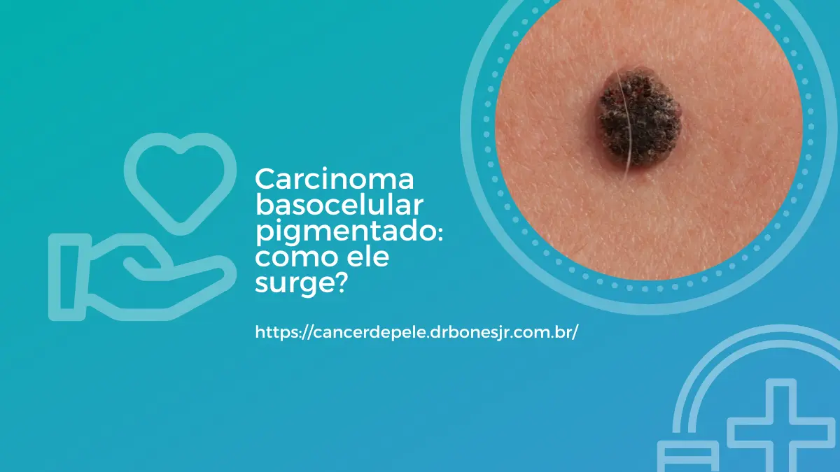 Carcinoma basocelular pigmentado como ele surge