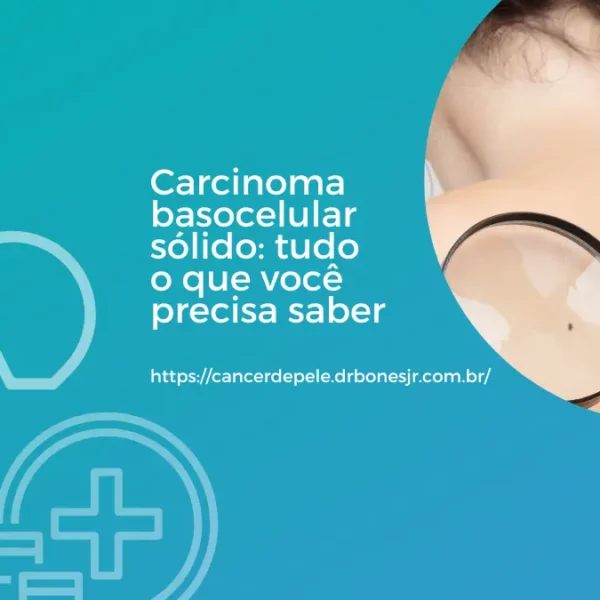 Carcinoma basocelular sólido tudo o que você precisa saber