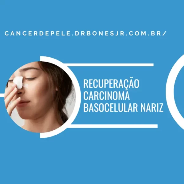 recuperação Carcinoma basocelular nariz