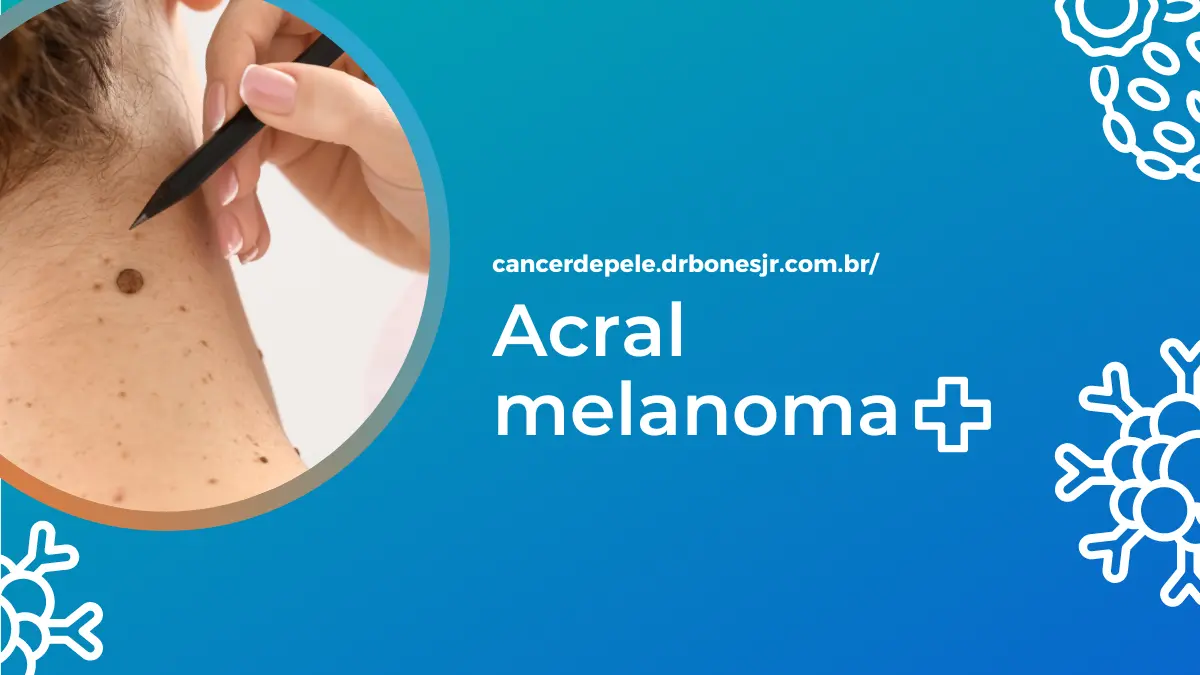 Acral melanoma
