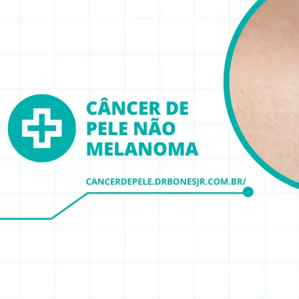 Câncer de pele não melanoma