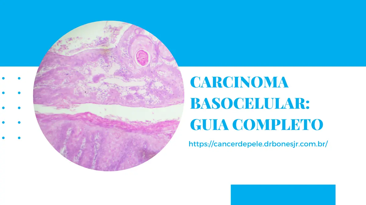 Carcinoma basocelular guia completo