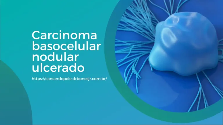 Carcinoma basocelular nodular ulcerado saiba o que é!