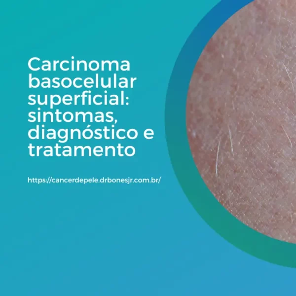 Carcinoma basocelular superficial sintomas, diagnóstico e tratamento