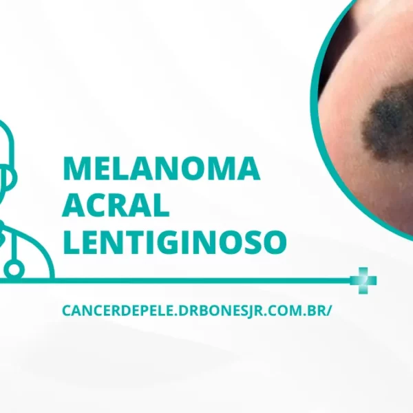 Melanoma acral lentiginoso