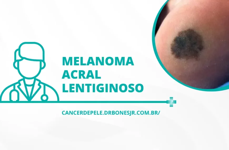 Melanoma acral lentiginoso