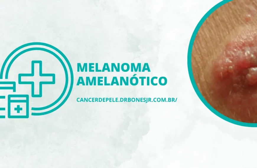 Melanoma amelanótico