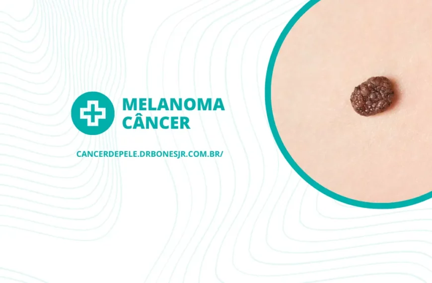 Melanoma câncer