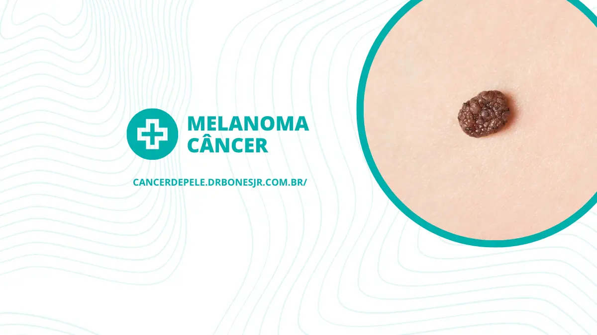 Melanoma câncer