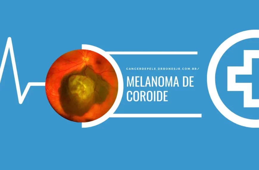 Melanoma de coroide