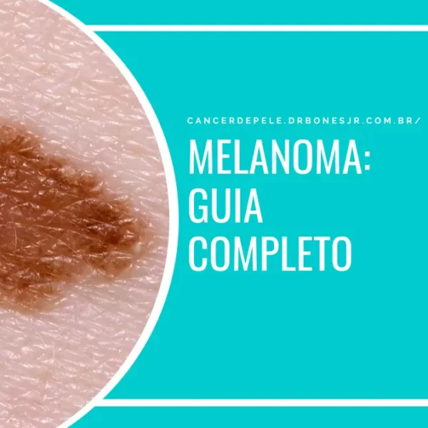 Melanoma guia completo