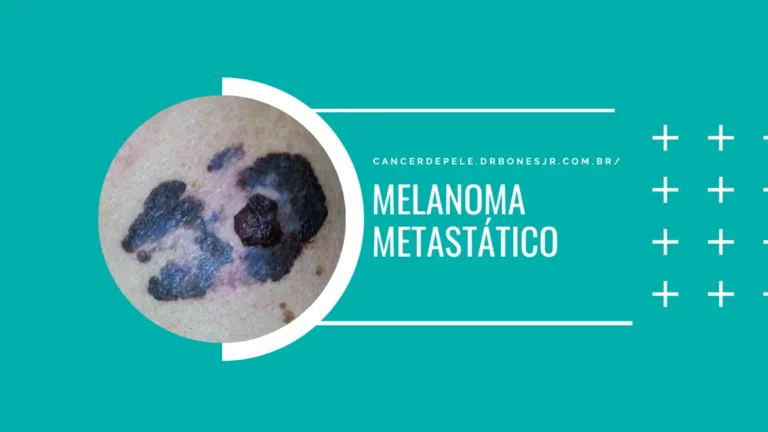 Melanoma metastático