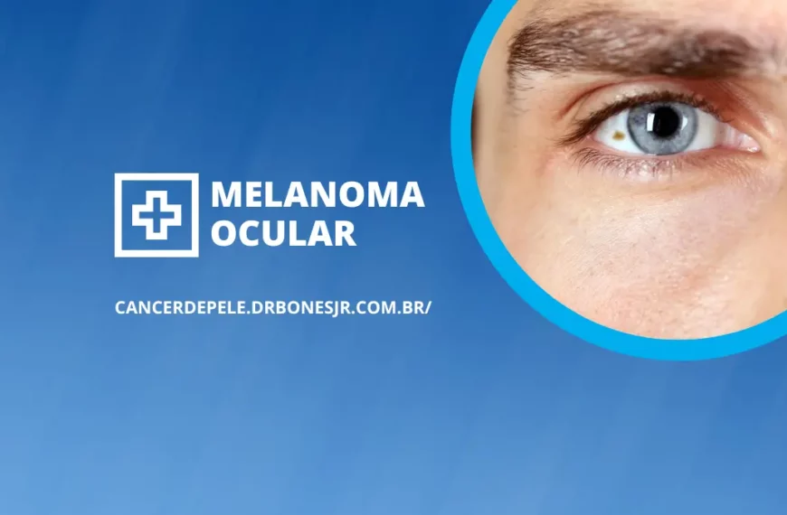 Melanoma ocular