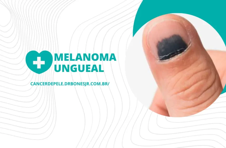 Melanoma ungueal