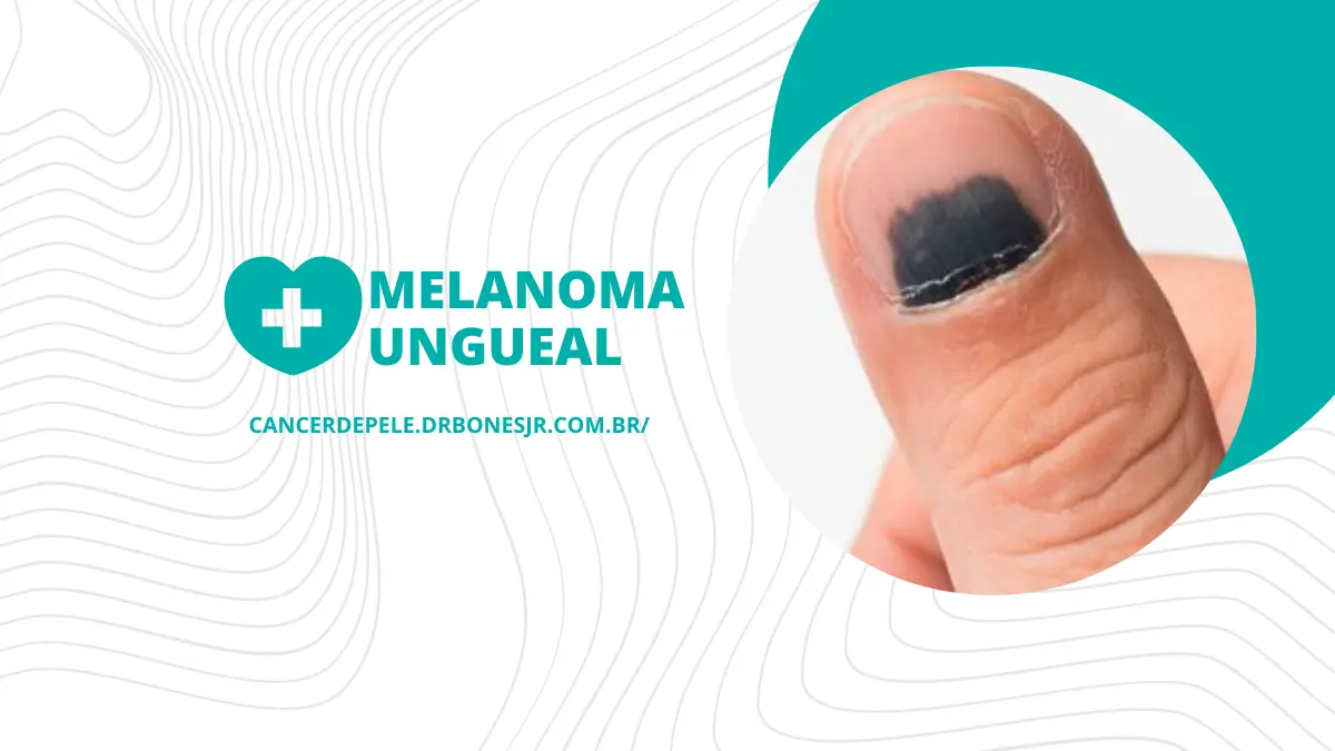 Melanoma ungueal