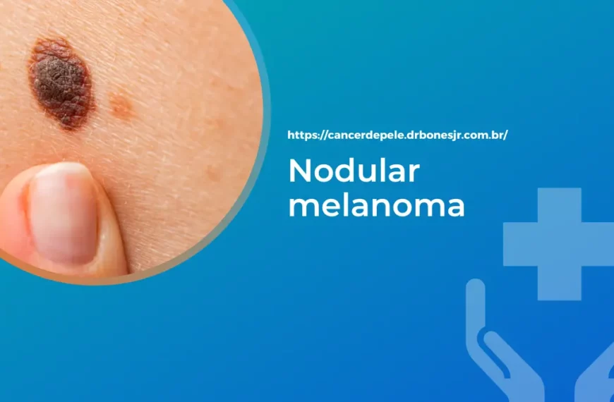 Nodular melanoma