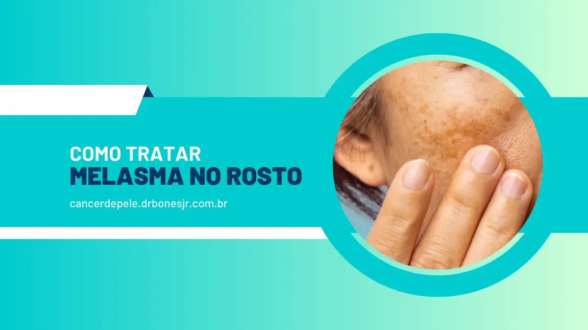 Como tratar o melasma no rosto Tudo o que você precisa saber